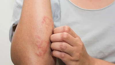 Lấy xong ổ giun lươn đã hết bệnh?
