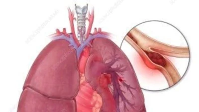 Nguy kịch do thuyên tắc phổi vì dùng thuốc tránh thai kéo dài 10 năm