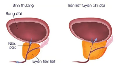Kỹ thuật hiện đại điều trị tăng sinh tuyến tiền liệt