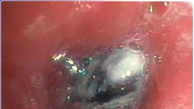Ho dai dẳng 1 năm không ngờ thủ phạm là hạt trái cây trong phế quản