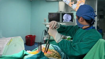 Bắt vít cột sống qua da cho người bệnh 59 tuổi bị vỡ đốt sống mất vững