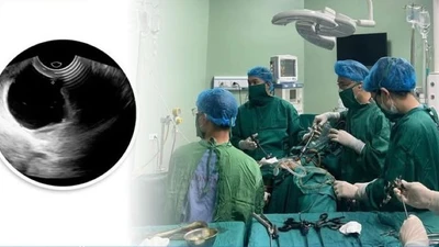 Đau vùng chậu thiếu nữ 28 tuổi mắc u nang ống Muller bẩm sinh hiếm gặp