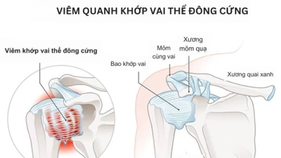 Địa chỉ vàng: Bệnh viện, phòng khám chẩn đoán tốt bệnh đau vai gáy