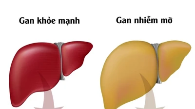 Loại đồ uống tốt cho người gan nhiễm mỡ