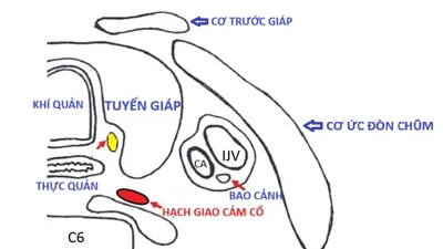 Sụp mi mắt có liên quan đến mổ tuyến giáp?