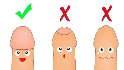 Nhiều hệ lụy khi cố lột bao quy đầu cho trẻ dưới 3 tuổi