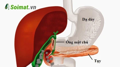 Cụ bà 77 tuổi nguy kịch vì sỏi túi mật gây tắc ruột non
