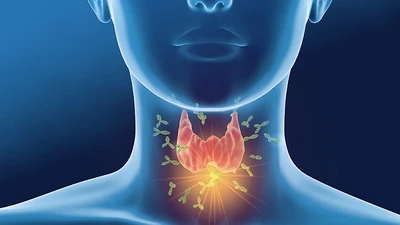 Cảnh giác các loại viêm nhiễm tuyến giáp ảnh hưởng sức khỏe