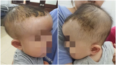 Bé 7 tháng tuổi tụ máu đầu nguy hiểm do ngã giường