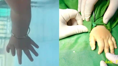 Cắt ngón tay thừa giúp trẻ tự tin phát triển toàn diện