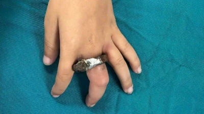 Ngón tay trẻ 6 tuổi sưng tím vì vòng khóa cửa