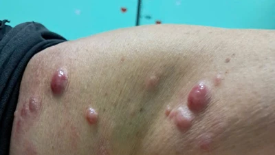 Sẩn cục bất thường ở da không ngờ u ác tính