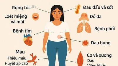 Co giật, rối loạn tâm thần... vì lupus ban đỏ ở trẻ