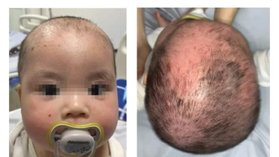 Tắm lá chữa viêm da đầu sai cách, trẻ 8 tháng bị bội nhiễm vi khuẩn nặng