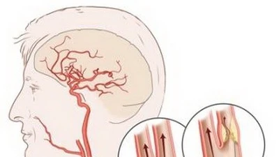 Cứu bệnh nhân đột quỵ não cấp do tắc động mạch cảnh