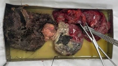 Cấp cứu bệnh nhân có khối u nang buồng trứng quái vỡ chứa răng và tóc