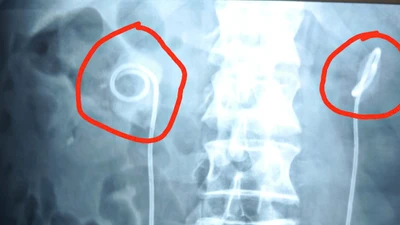 Để sonde JJ quá 2 năm, sỏi bám vòng quanh gây thận ứ nước, nguy cơ ngừng tim