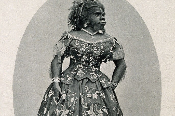 Julia Pastrana sinh năm 1834 tại Mexico. Bà mắc phải hai căn bệnh hiếm gặp, trong đó một chứng bệnh di truyền gọi là hypertrichosis terminalis.