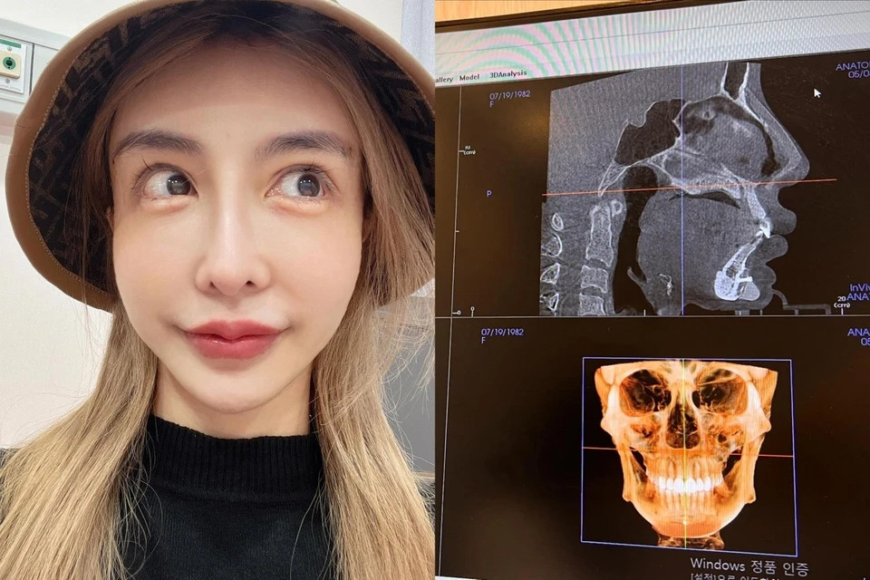 Soc nang anh chup X-quang cua nguoi mau nghien dao keo