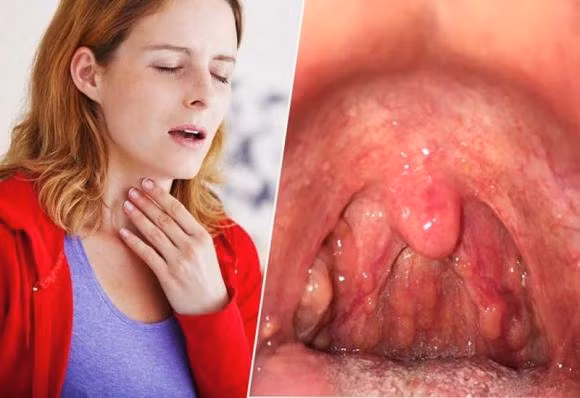 Viem hong mua he, an 5 mon nay dam bao nhanh khoi