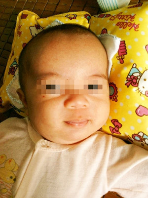 Cháu K. sau khi phẫu thuật thành công.