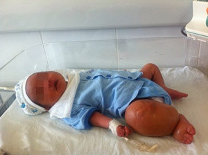 Cháu A với chân phải phù to bất thường. Ảnh: Khánh Chi.