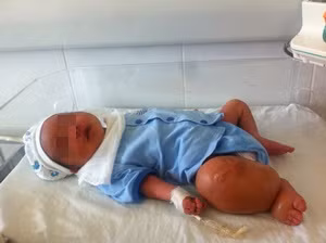 Cháu A với chân phải phù to bất thường. Ảnh: Khánh Chi.