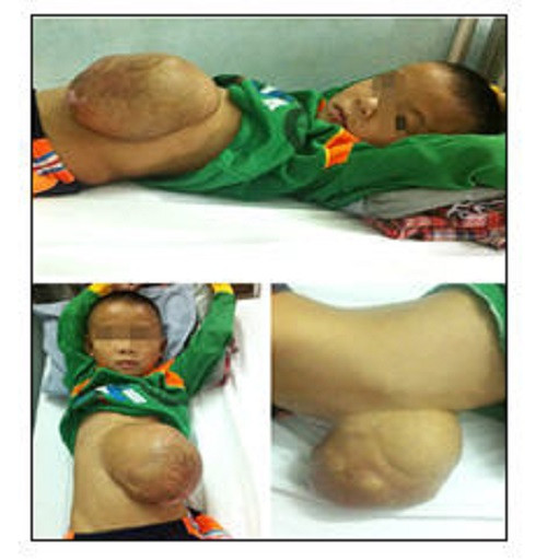 Bệnh nhi Choyang với khối thoát vị dây rốn khổng lồ. Ảnh: Khánh Chi.