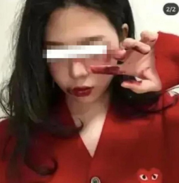 Loạt bạn trẻ xuất hiện với gương mặt bầm tím như bị bạo hành - Hình 3 Loat ban tre xuat hien voi guong mat bam tim nhu bi bao hanh-Hinh-3