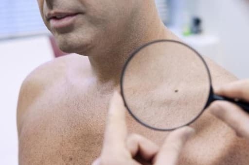 5 van de lon ve da nay co the la do ung thu tim den cua-Hinh-2