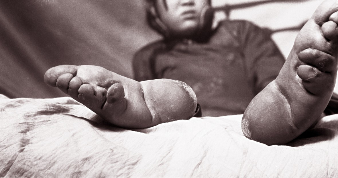 Đôi chân dị thường của một phụ nữ Trung Quốc. Tục bó chân khiến các thiếu nữ chịu đau đớn để có bàn chân nhỏ, chuẩn mực của cái đẹp trong quá khứ ở đất nước này.