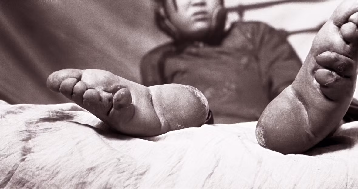 Đôi chân dị thường của một phụ nữ Trung Quốc. Tục bó chân khiến các thiếu nữ chịu đau đớn để có bàn chân nhỏ, chuẩn mực của cái đẹp trong quá khứ ở đất nước này.