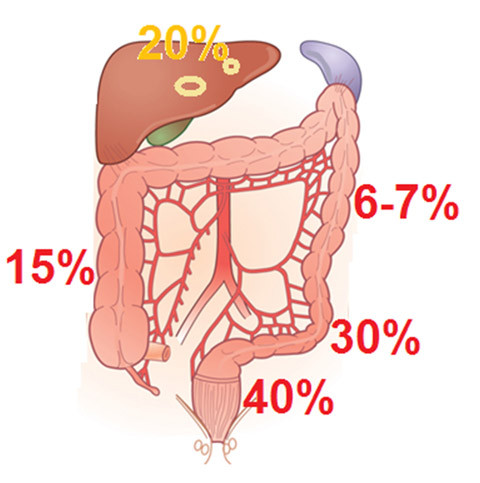 Những vị trí thường gặp trong UTĐTT.