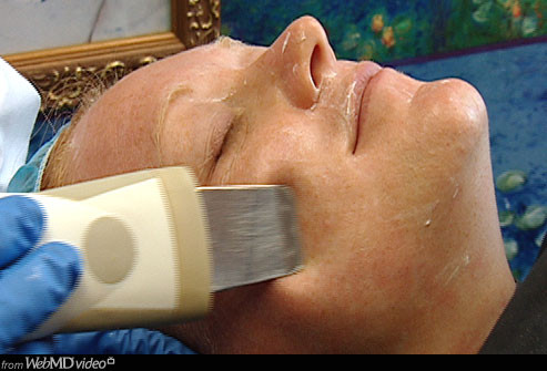  Điều trị siêu mài mòn da (Microdermabrasion): Liệu pháp này là tẩy đi những lớp trên cùng của da. Cách điều trị này rất hiệu quả đối với da bị tổn hại nghiêm trọng bởi ánh nắng mặt trời, nhưng nó sẽ gây chảy máu và cần 1 tuần để phục hồi. Microdermabrasion còn được gọi là "lột điện", các tinh thể cực nhỏ sẽ làm nổ da, lấy đi các tế bào chết lớp ngoài. Điều này có thể làm giảm nếp nhăn, đốm nâu, và những vết sẹo mụn trứng cá nhẹ.