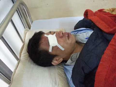 NVBV Quách Hồng Hào vẫn bị hôn mê, mặt bị đa chấn thương, phù nề, rách mí mắt bên phải, phải khâu nhiều mũi.