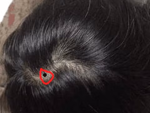 br/> 2. Có nốt ruồi trên tóc: Nốt ruồi trên tóc được gọi là tắc ẩn vì chúng được che giấu rất tốt, đó là một dấu hiệu tốt. 