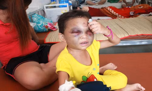 Cháu Ngân đang được điều trị tại BVĐK Bình Dương từ sự chăm sóc của những người hàng xóm.