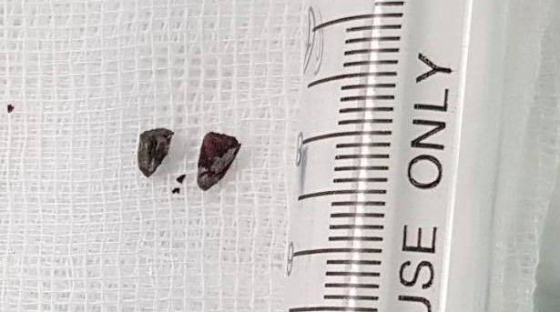 Manh phao tu che gam vao nguoi mot thanh nien dem giao thua