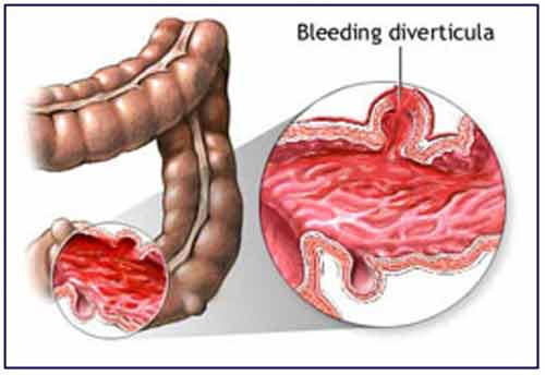 Các báo cáo cho rằng một người bị ung thư đại tràng giai đoạn cuối sẽ có khả năng có những thay đổi đáng chú ý trong thói quen ruột.