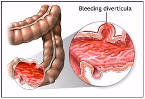 Các báo cáo cho rằng một người bị ung thư đại tràng giai đoạn cuối sẽ có khả năng có những thay đổi đáng chú ý trong thói quen ruột.