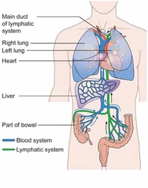 Điều trị ung thư đại tràng ở giai đoạn muộn hết sức khó khăn.