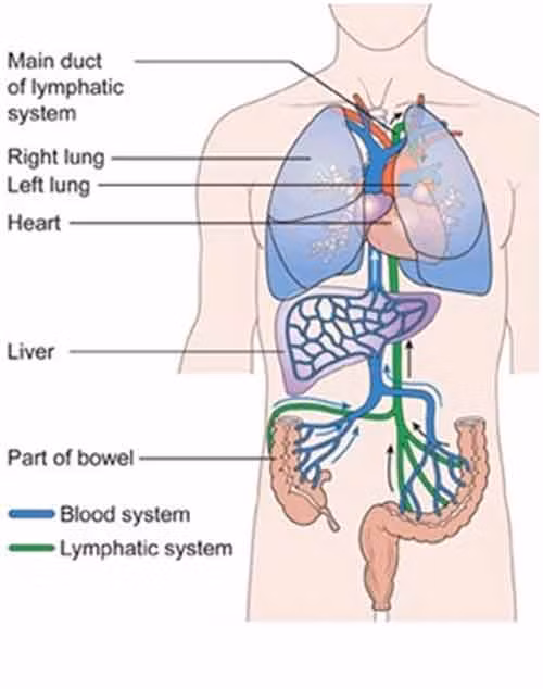 Điều trị ung thư đại tràng ở giai đoạn muộn hết sức khó khăn.