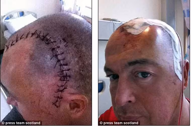 Thật kỳ diệu, anh đã vượt qua và còn khỏe mạnh để tổ chức hôn lễ với người bạn đời Gillian, 33 tuổi, và tổ chức sinh nhật đầu tiên cho con gái Anna.