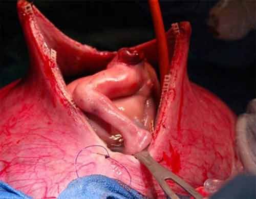 Phẫu thuật cắt khối u cho bào thai trong bụng mẹ. Sau khi đã mang thai được 6 tháng, Keri Mc Cartney, sống ở Laredo, bang Texas (Mỹ), mới đi siêu âm và vô cùng lo sợ khi phát hiện ra có một khối u nguy hiểm mọc ở xương cụt của thai nhi. Khối u này gây cản trở việc máu cung cấp cho cơ thể thai nhi và có thể khiến cho bé tử vong.