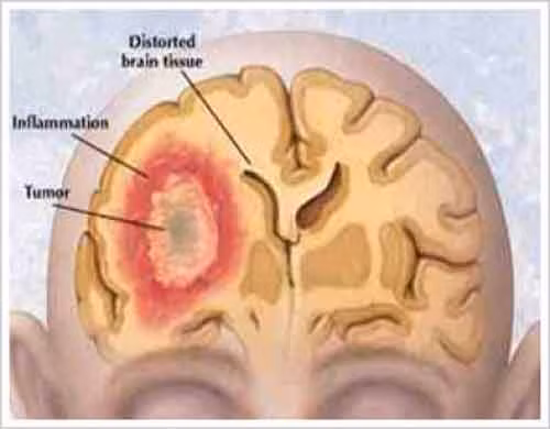 Bệnh nhân ung thư não phát hiện bệnh sớm, kịp thời điều trị giúp tỷ lệ sống sót cao hơn.