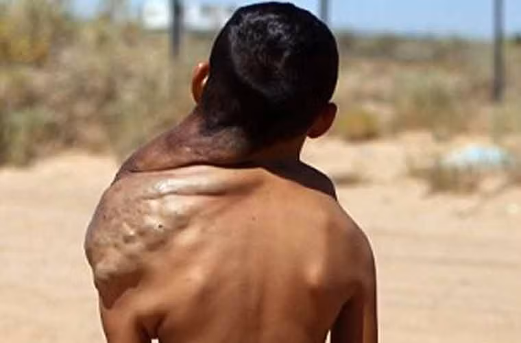 Cậu bé 10 tuổi này không chỉ chịu đựng sự đau đớn từ khối u khổng lồ mà còn phải đối mặt với những ánh mắt kỳ thị, soi mói của những người xa lạ. Mẹ của Jose cho biết: "Điều này rất khó khăn. Người ta cứ nhìn chằm chằm vào thằng bé. Một vài người còn tỏ thái độ miệt thị với thằng bé”.