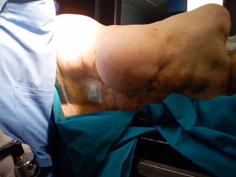 8 - Bệnh Dercum (u mỡ đau). Bệnh đặc trưng bởi sự hiện diện của nhiều u mỡ, khi ấn vào có cảm giác đau; chủ yếu ở thân mình, phần trên của chi trên và chi dưới. Dercum là bệnh khá hiếm và vẫn còn là một bí ẩn đối với nhân loại.