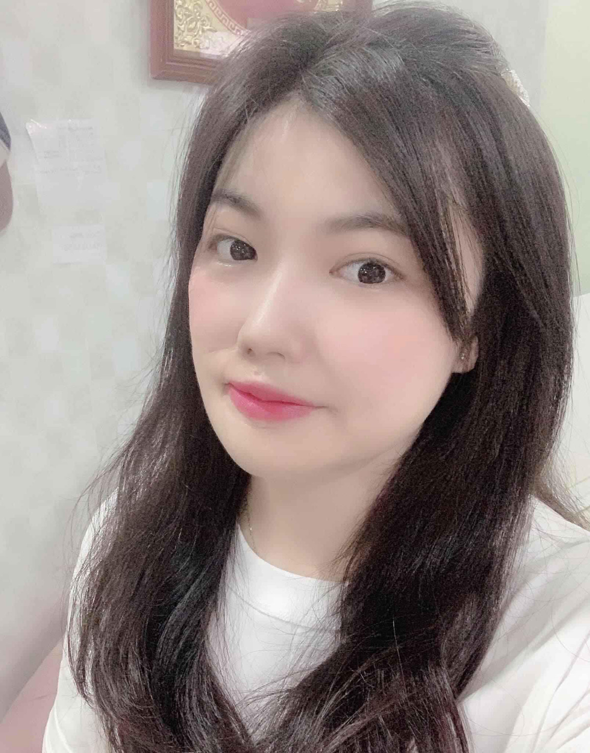 Rơi nước mắt hành trình đau đớn lấy lại diện mạo của cô gái bị tạt axit Roi nuoc mat hanh trinh dau don lay lai dien mao cua co gai bi tat axit