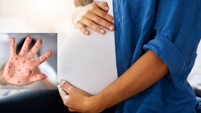 Benh tay chan mieng co gay rui ro cho thai ky?