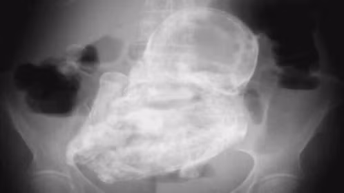 Bào thai 40 tuổi qua ảnh X-quang